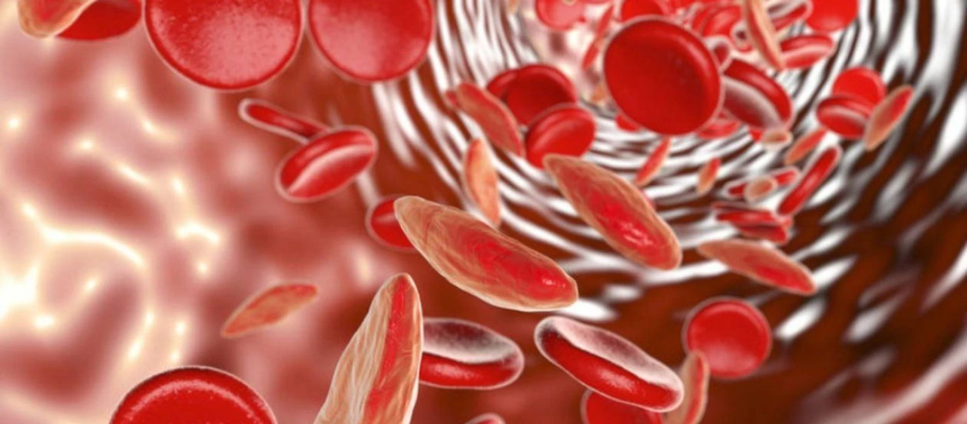 Τα συμπτώματα που φανερώνουν ότι έχετε ανεπάρκεια σιδήρου